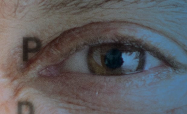 Surgical-Astigmatism-Premier-Glaucoma-Eye-Care-Flint-MI